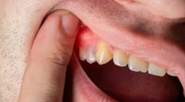 كيف تحمى نفسك من أمراض اللثة