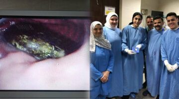 طبيبة تستخرج موبايل من معدة مريض في مستشفى الباطنة بالمنصورة
